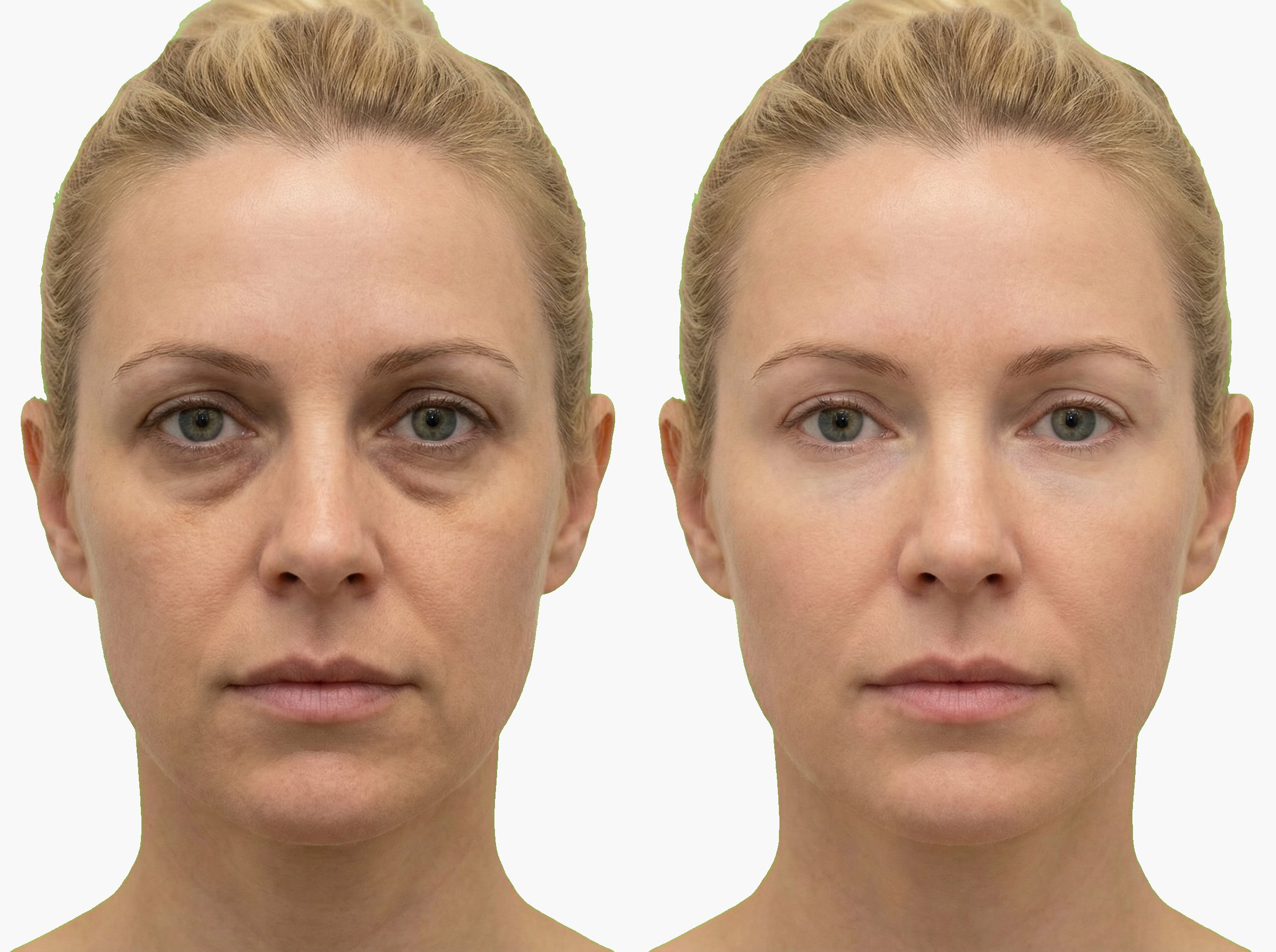 Antes y después de corrección de ojeras con ácido hialurónico