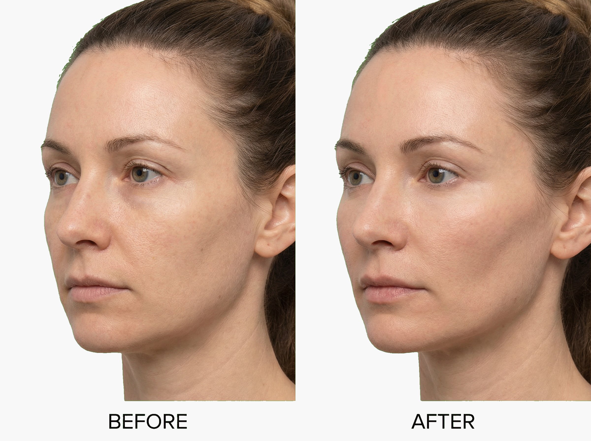 Antes y después de proyección de pómulos con ácido hialurónico