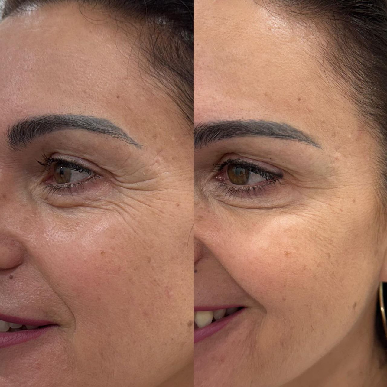 Antes y después de tratamiento de botox en patas de gallo