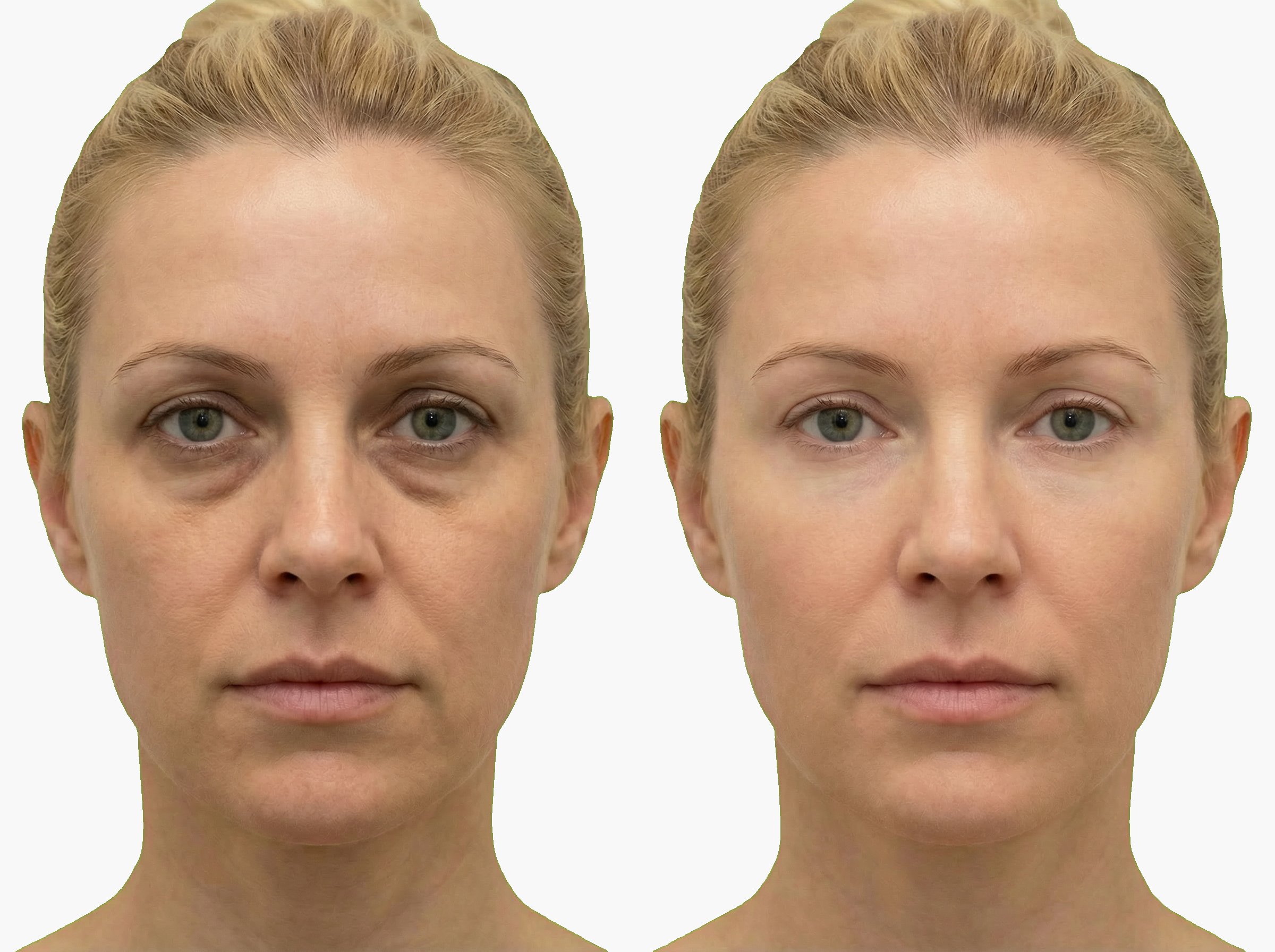 Antes y después de mejora de textura de piel con hidratación vital