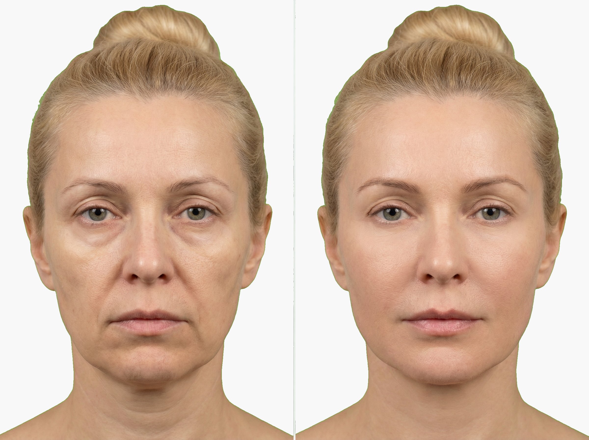 Antes y después de rejuvenecimiento facial con Sculptra