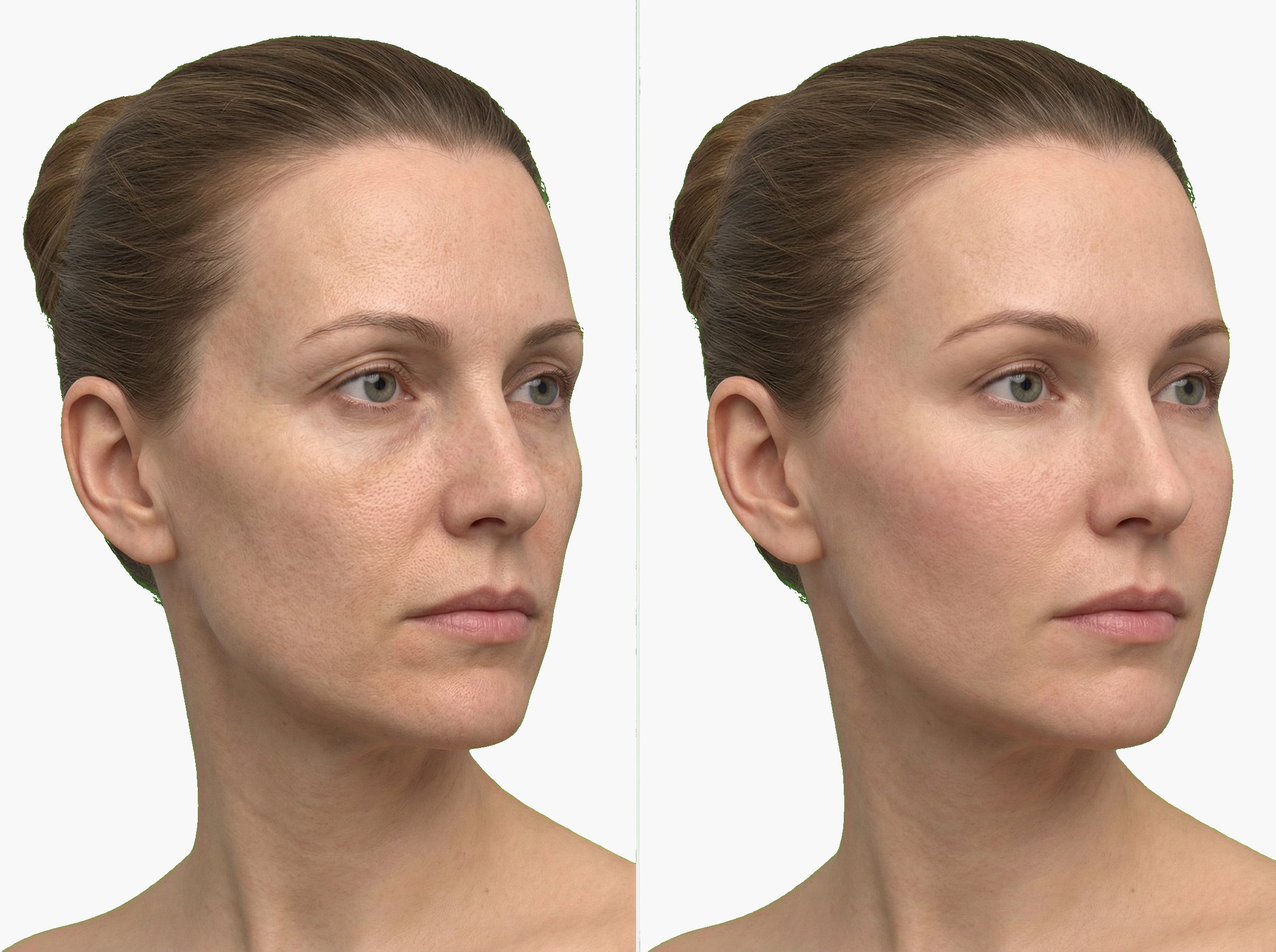 Antes y después de recuperación de volumen facial con Sculptra